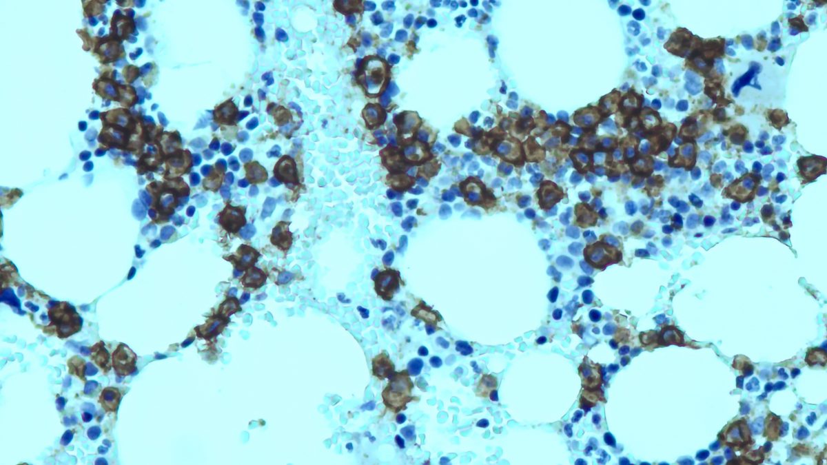 Agoaspirato Polmonare Su Lesione Necrotica Cytomatrix